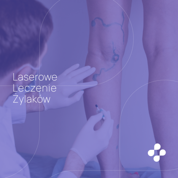 Laserowe leczenie żylaków (EVLT)